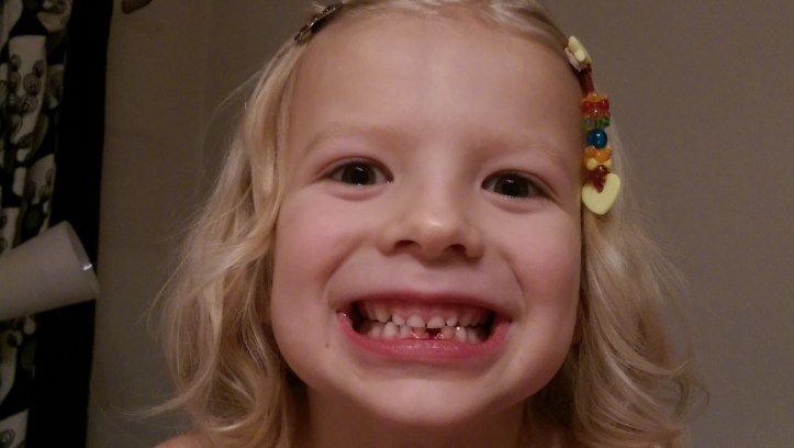 En tand fattigare, och så HIMLA glad. Den som tittar noga ser rester på underläppen efter operationen 